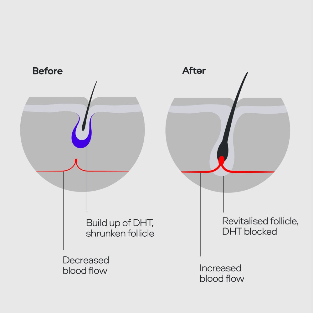 Sons Minoxidil 5% Solution 3-Month Supply (3 x 60ml)