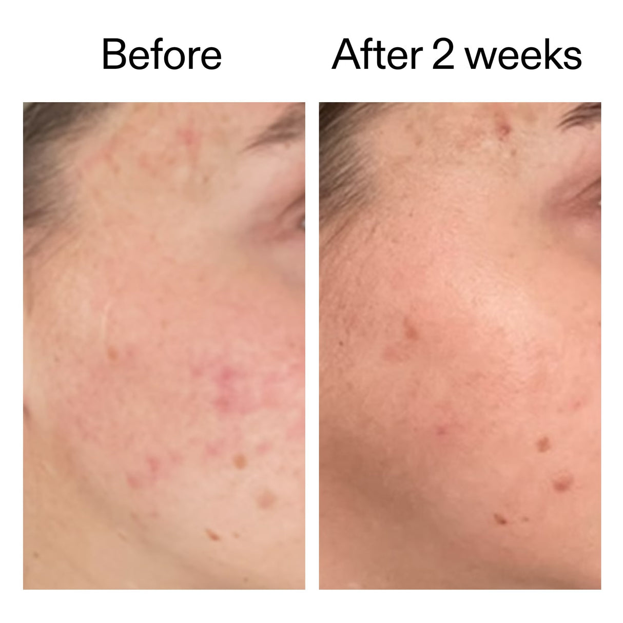 the-inkey-list-dioic-acid-serum-1101570-2