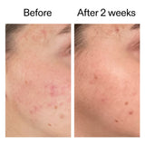 the-inkey-list-dioic-acid-serum-1101570-2