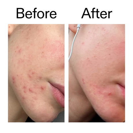 the-inkey-list-blemish-clearing-solution-2-novoretin-50ml-1096831-2